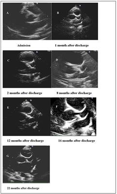 Henoch-Schönlein Purpura /IgA Vasculitis Complicated by Coronary Artery Aneurysm: A Case Report and Literature Review